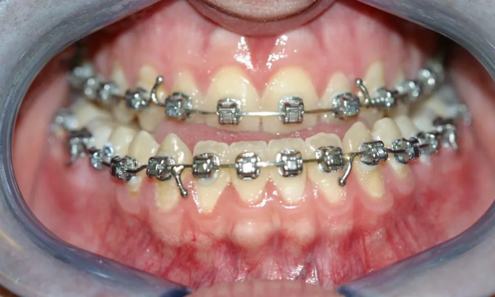 Clinical photo from Joe's corrective jaw surgery case
